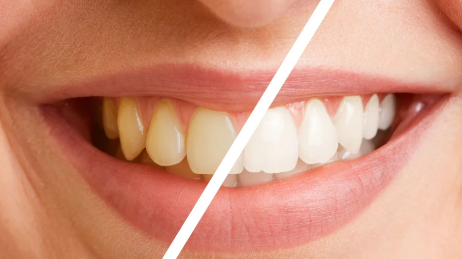 How Long Do Teeth Whitening Results Last?